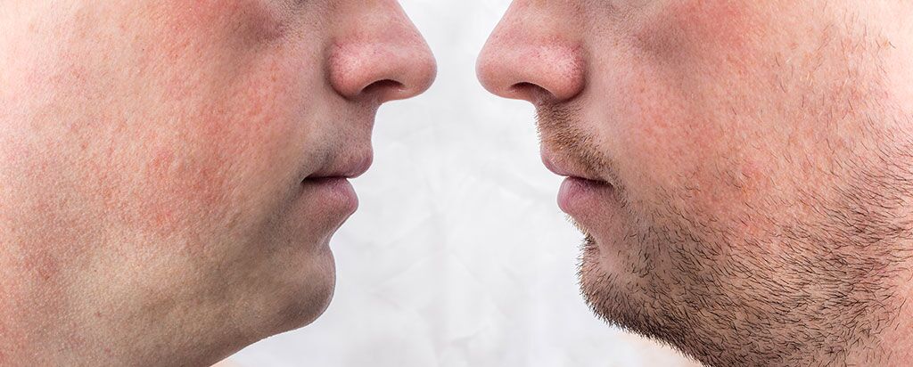 Before and after beard transplantation